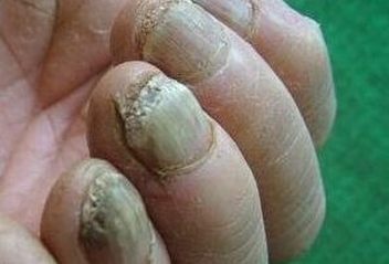 儿童得灰指甲的病因有什么