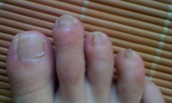 多种病因引发的灰指甲