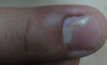 患灰指甲的有哪些要素 