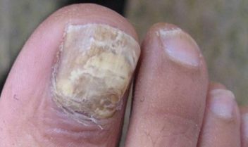 患上灰指甲会有多大的危害
