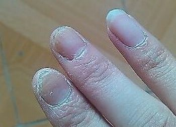 灰指甲的初期病情表现