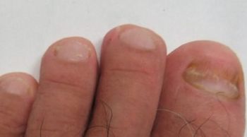 不一样类型灰指甲的症状表现 