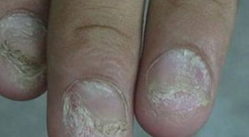 灰指甲病因 灰指甲甲癣的导致条件