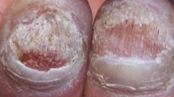 灰指甲病因分析