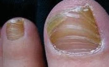 灰指甲病因及防范