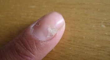 灰指甲不除掉的危害