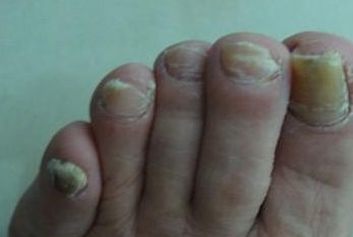 灰指甲不可轻视的危害 