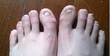 灰指甲常见致病因素
