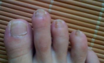 灰指甲常常看见的症状有哪些