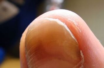 灰指甲初期病情的辨别措施