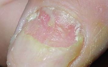 灰指甲初期有什么详细症状