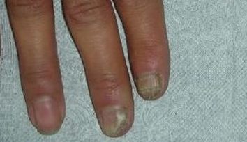灰指甲初期有哪些详细症状