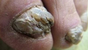灰指甲的并发症详细的有啥