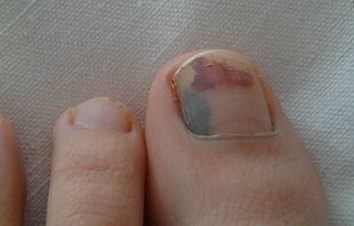 灰指甲的病理病因有什么 