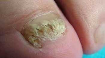 灰指甲的导致条件是哪些