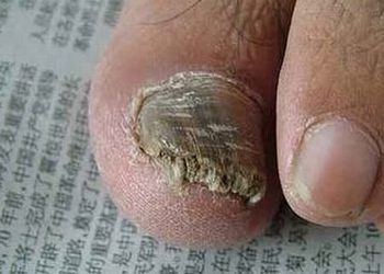 灰指甲的病因是哪些呢