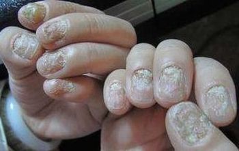 灰指甲的常见不一样类型症状有哪些