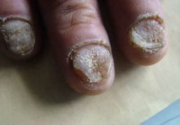 导致灰指甲有什么原因