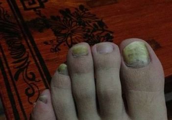 到底灰指甲是如何导致的呢