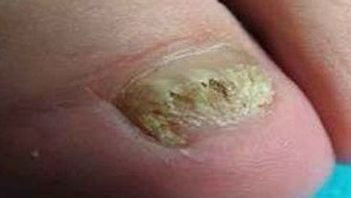 得了灰指甲有怎样的症状