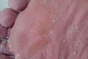 治疗脚气哪家医院好