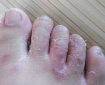 医生提示脚气患者该小心哪些问题