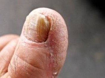 初次得脚气怎么治能去根
