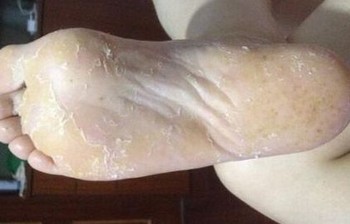 脚底长水泡是脚气导致的吗