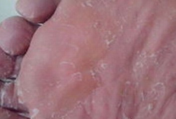 脚气治不好走路都费劲