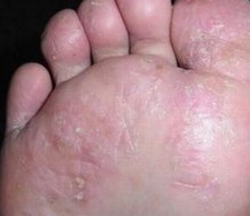 治愈脚气重燃期待