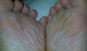 有脚气应该怎样