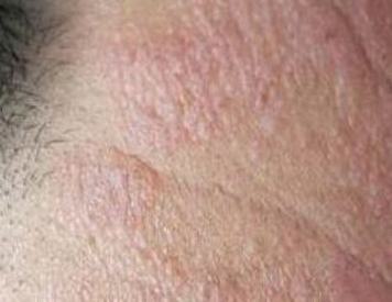 疥疮对皮肤有哪些损害