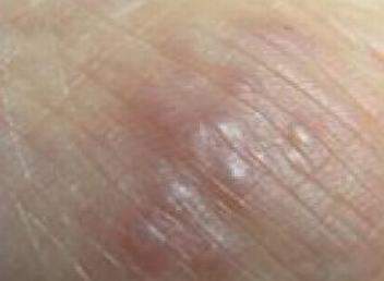 疥疮治疗时期注意什么