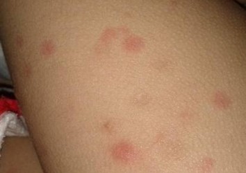 皮肤异痒的主要有什么症状及病因