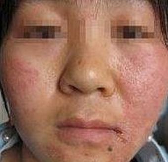 过敏性皮炎的治疗方法有哪些
