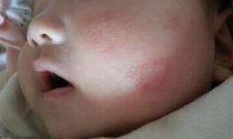 过敏性皮炎的早期的症状有哪些