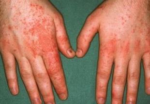 过敏性皮炎对患者有什么伤害