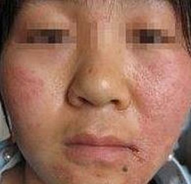 被黄蜂蜇了怎么办