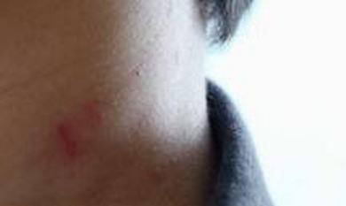 面部脂溢性皮炎有哪些常常看见的症状