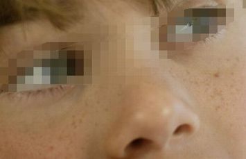 雀斑的保养秘笈病因种类