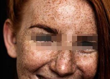 雀斑是如何形成的的呢