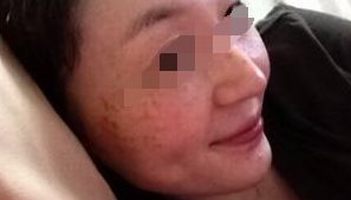 雀斑都长什么样