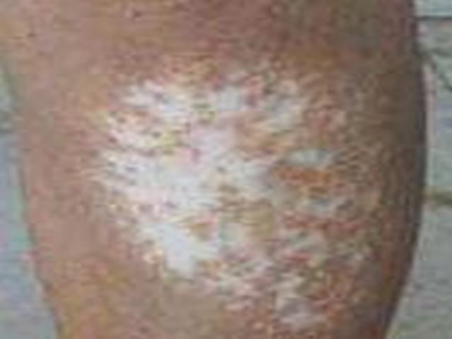 白癜风患者的调节自身和治疗