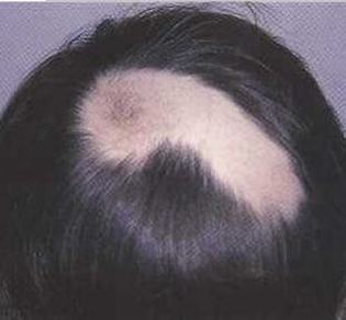 斑秃患者怎么做才能恢复往日秀发