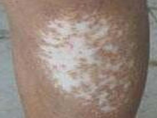 局限性硬皮病饮食这一方面要小心什么
