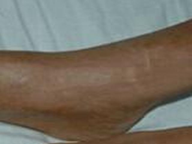 慢性硬皮病如何避免 