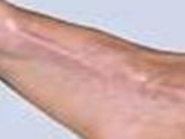 如何减轻硬皮病的症状呢