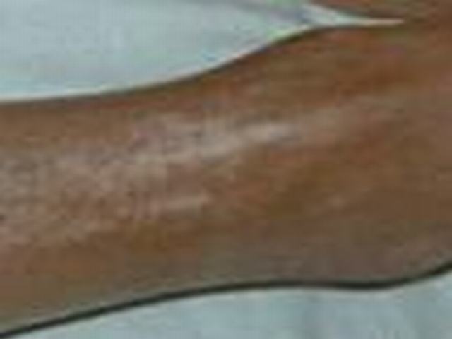 系统性硬皮病体现体现有哪些