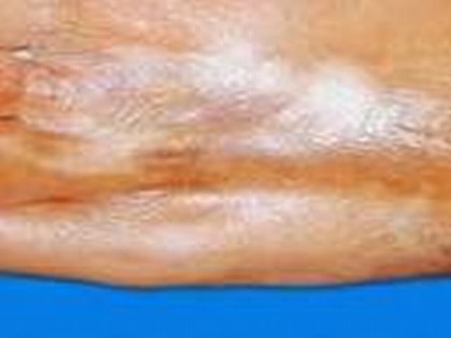 系统性硬皮病消化系统表现如何