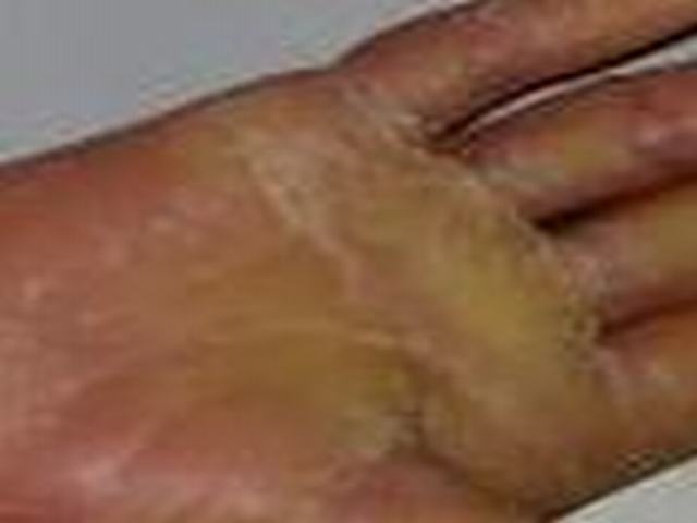硬斑病的食疗方法有哪些